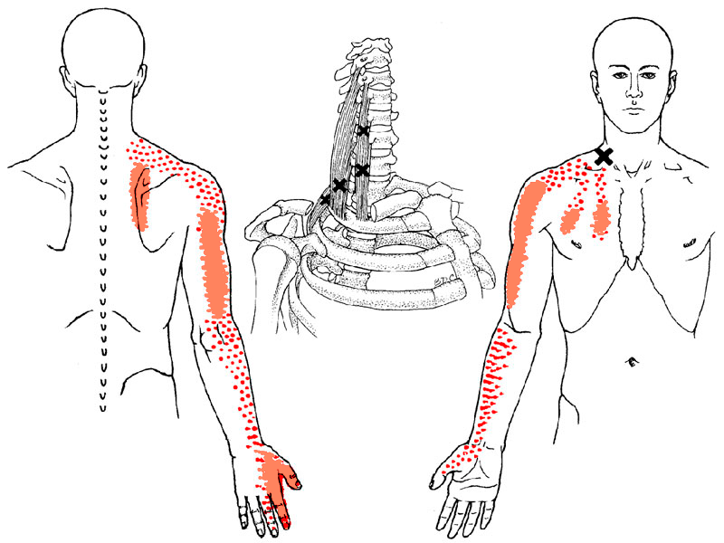 Корешковый синдром (радикулопатия) пояснично-крестцового, грудного и шейного отдела